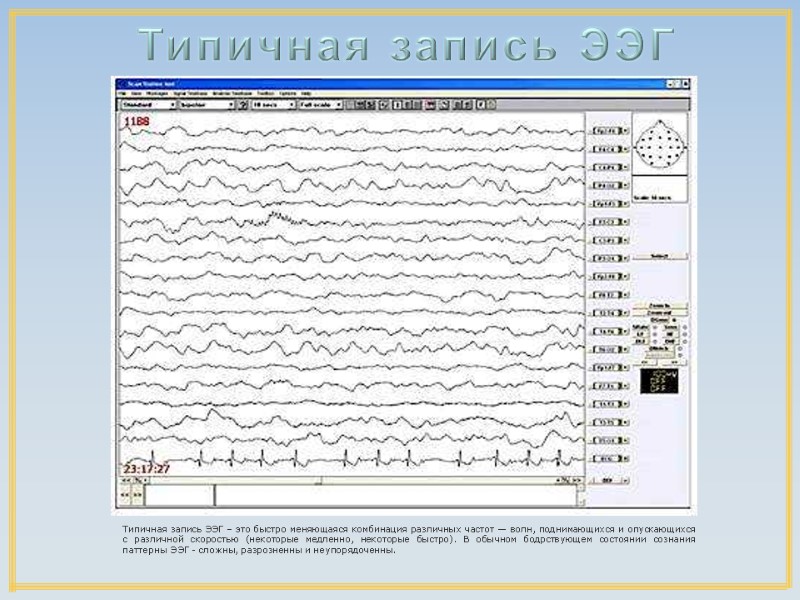 Типичная запись ЭЭГ – это быстро меняющаяся комбинация различных частот — волн, поднимающихся и Типичная запись ЭЭГ – это быстро меняющаяся комбинация различных частот — волн, поднимающихся и
